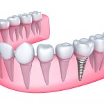 Implant Dentist at Downtown Dental Services located in Cleveland, OH Area