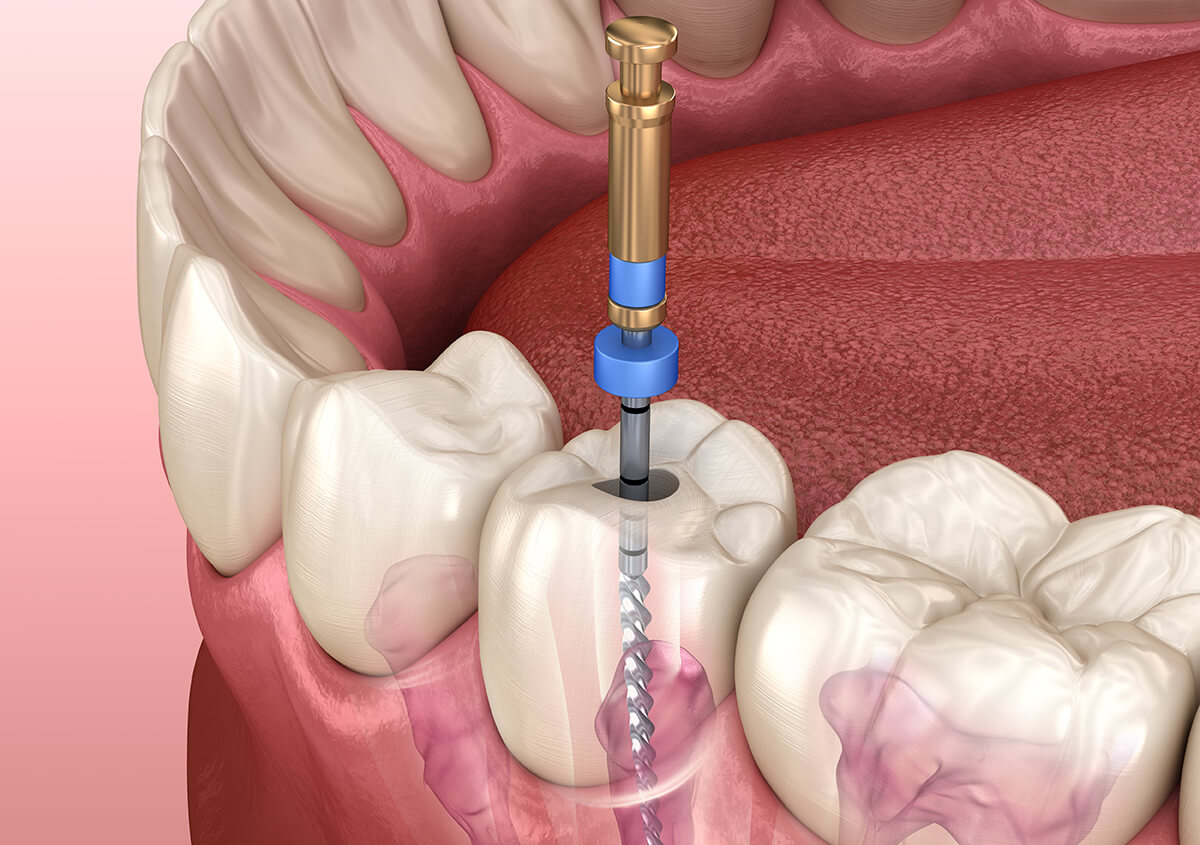 Cleveland dentist explains how root canal therapy can save your natural tooth