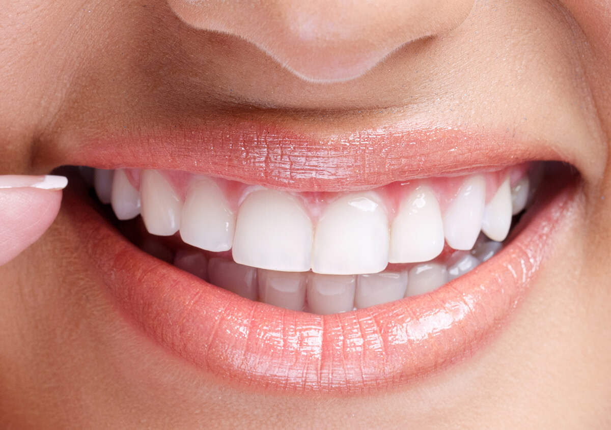 Top 7 Benefits of Professional Teeth Whitening