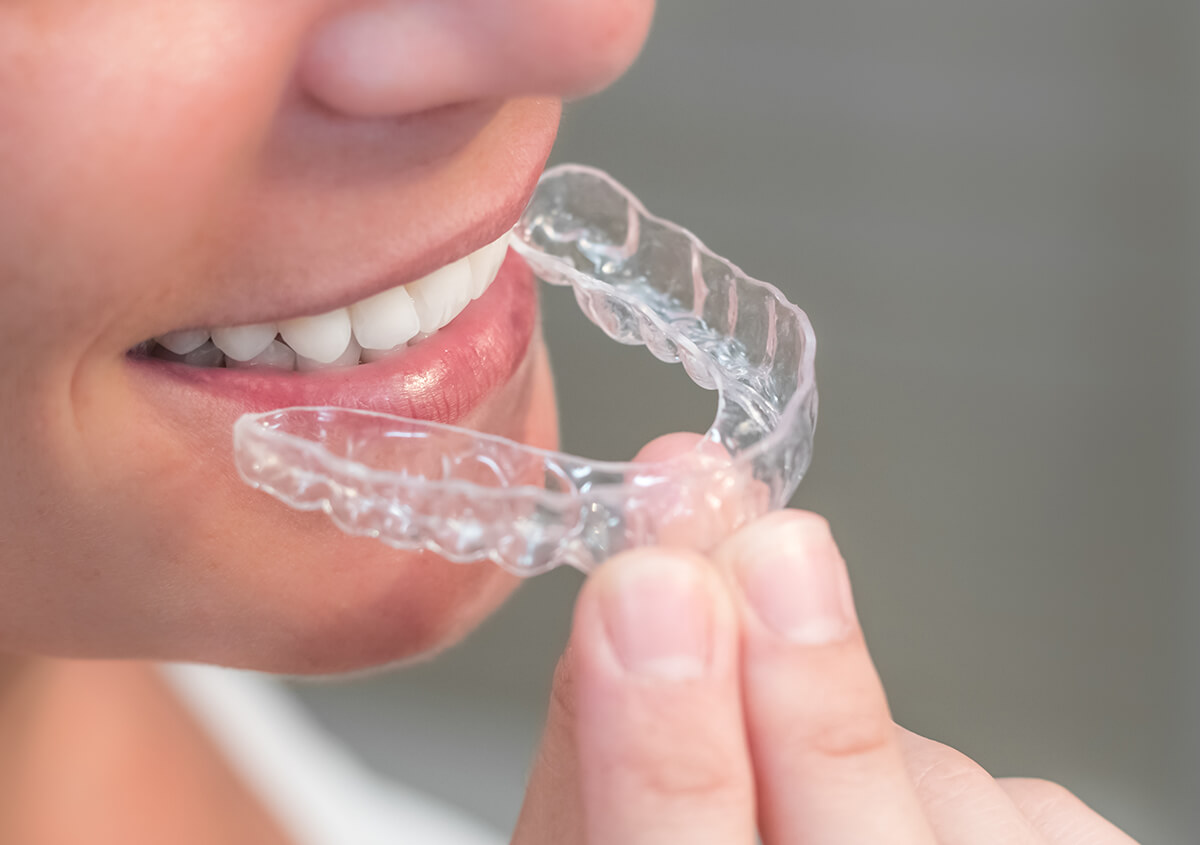 Clear Teeth Aligners in Cleveland OH Area