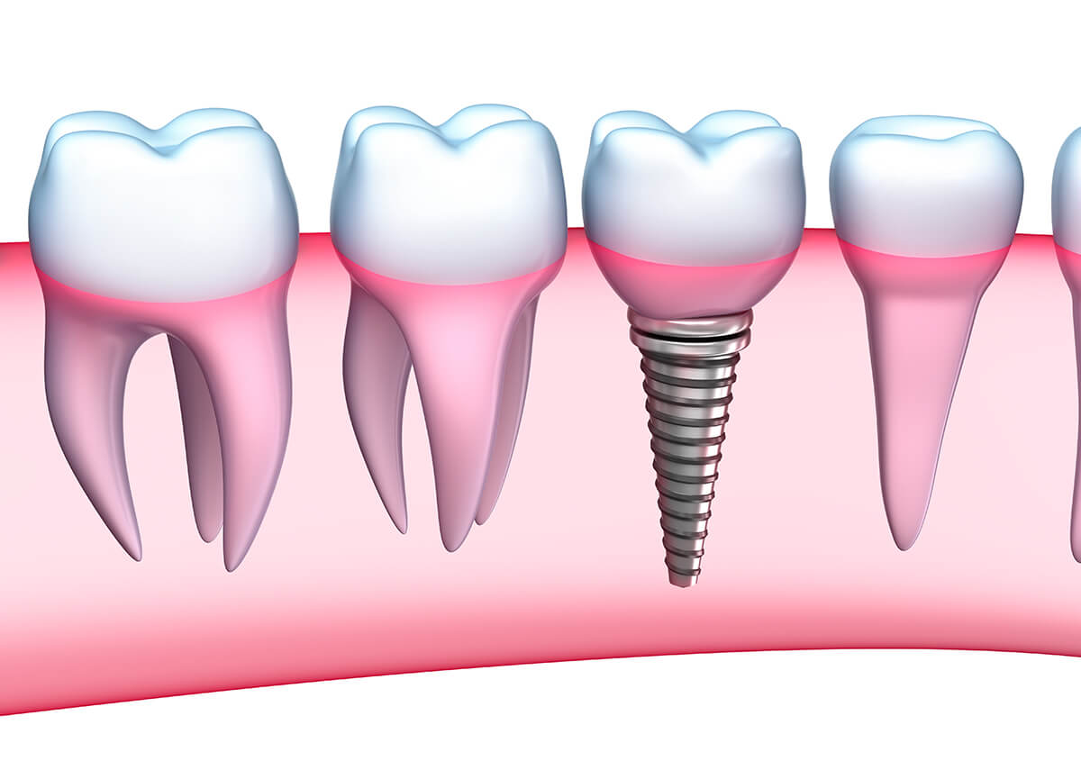 Dental Implant Recovery Time in Cleveland OH Area