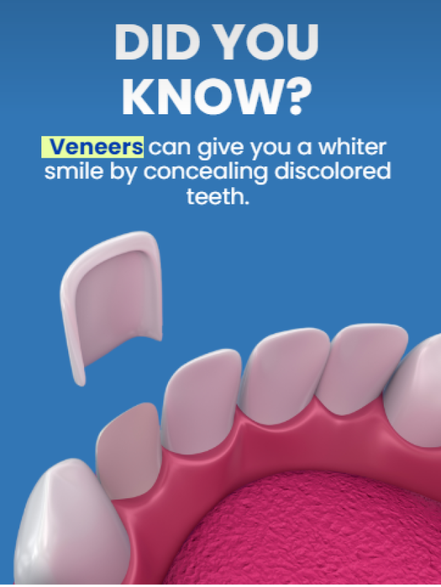 Did you know? Veneers can give you a whiter